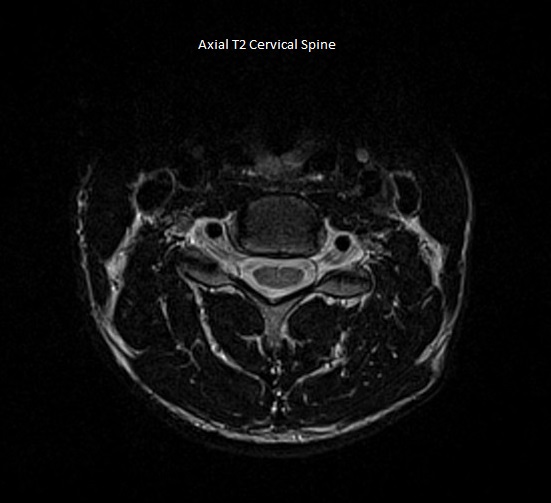 Axial T2 Cervical Spine