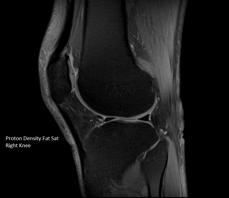 PDfs Sag Right Knee