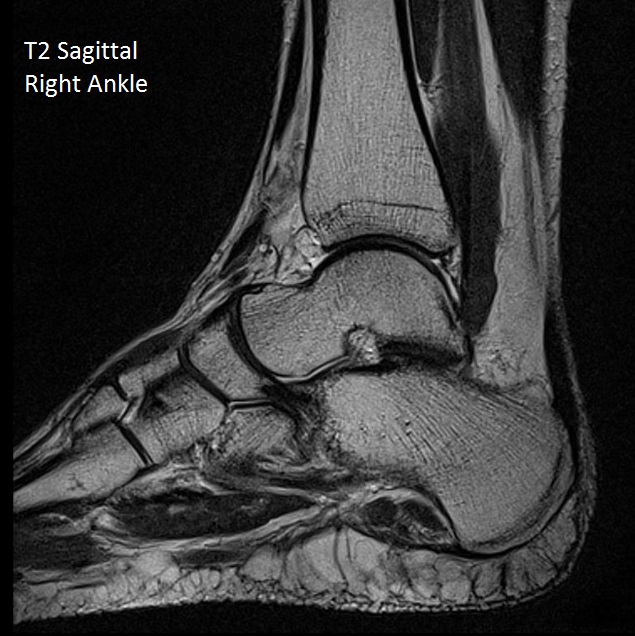 T2 Sag Right ankle